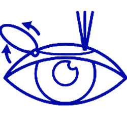جراحی فمتولیزیک