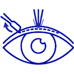 جراحی پی آر کی