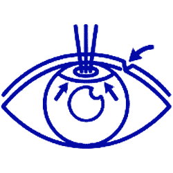جراحی اسمایل